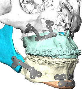 NEW外科学 = NEW Surgery NEW外科学 = NEW Surgery LVHN Expands Robotic-Assisted Knee
